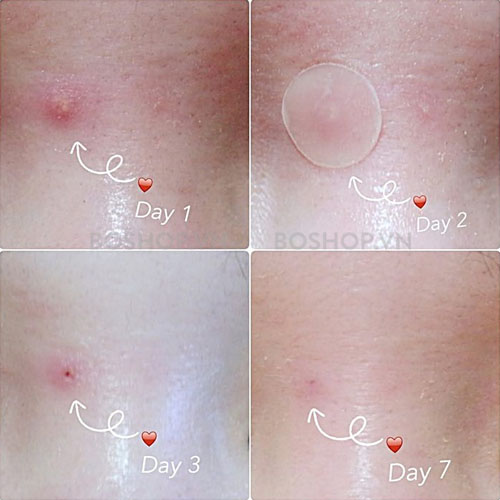 dan-tri-mun-ciracle-red-spot-acne-pimple-path-24-mieng-boshop-3.jpg