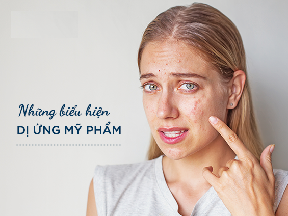 Viêm da dị ứng do mỹ phẩm hết hạn