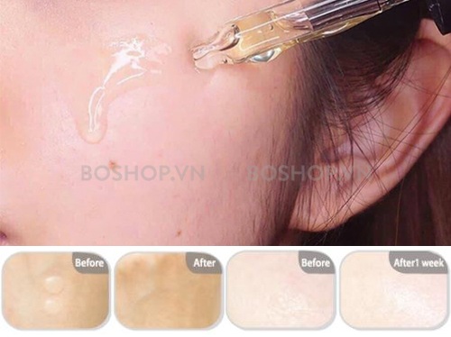 serum-tri-nam-dongsung-rannce-45ml-boshop-7-jpg