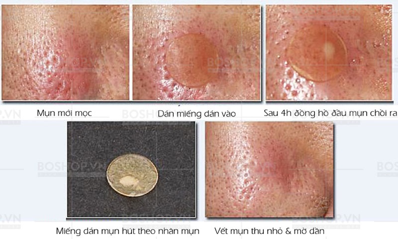 dan-tri-mun-ciracle-red-spot-acne-pimple-path-24-mieng-boshop-4-1-jpg