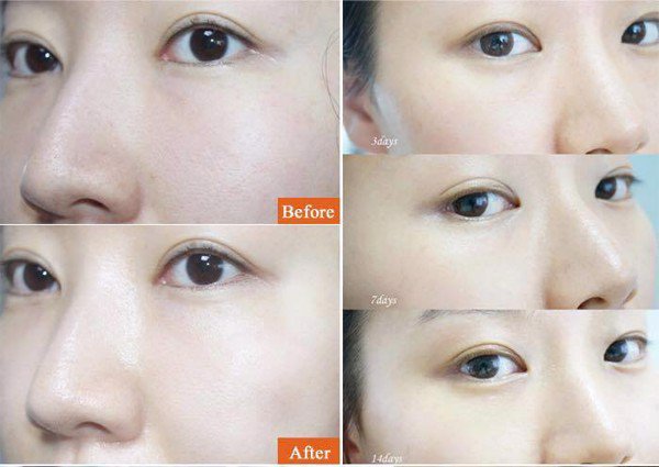 hieu-qua-sau-14-ngay-su-dung-innerb-aqua-bank