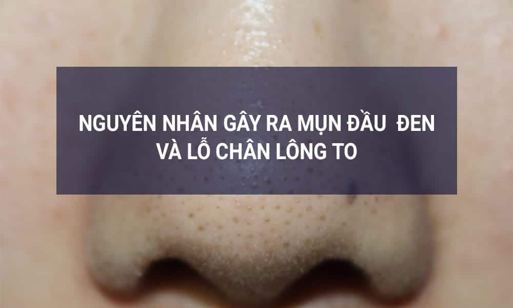 nguyen-nhan-lo-chan-long-to-mun-dau-den-la-khong-su-dung-mat-na-tri-mun-dau-den-tot-nhat-jpg