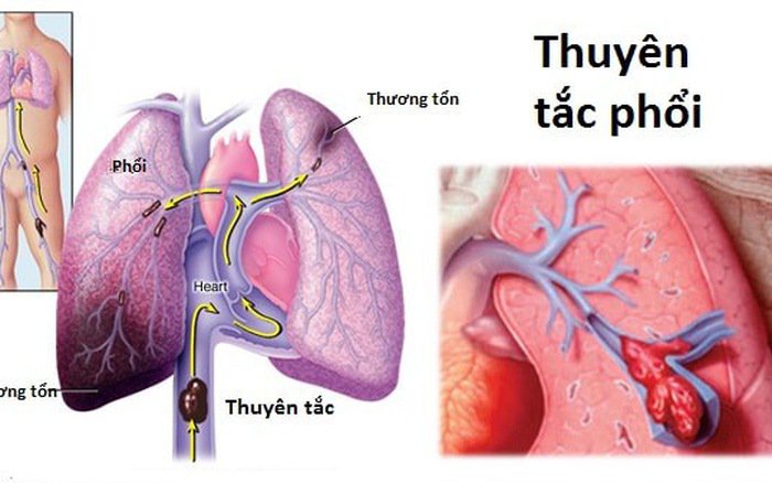 Hút mỡ bụng liệu có an toàn???? Xem ngay để biết thêm thông tin 5e252579d0445-hut-mo-co-the-gay-ra-thuyen-tac-mach-phoi