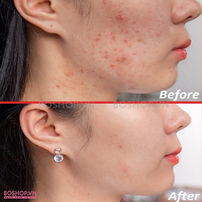 kem-cham-mun-neutrogena-on-spot-acne-treatment-21gr-boshop-8-jpg