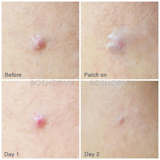 dan-giam-sung-mun-innisfree-bija-trouble-focusing-patch-9-mieng-boshop-3-jpg