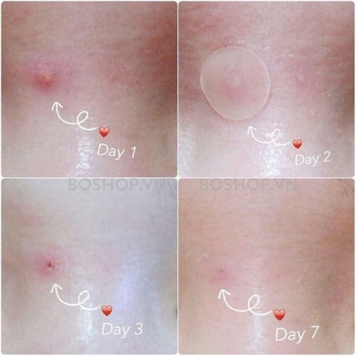 dan-mun-cosrx-clear-fit-master-patch-18-mieng-boshop-2-png