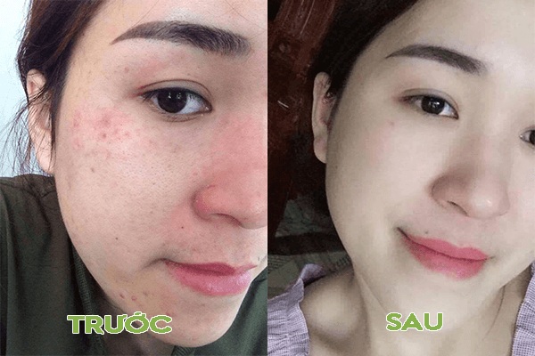 hieu-qua-sau-khi-dung-kem-tri-mun-tham-kracie-hadabisei-acne-care-medicated-whitening-cream-jpg