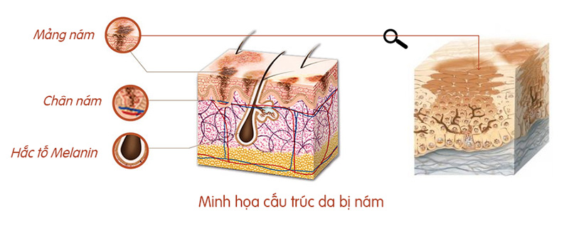 boc-phot-cac-cach-tri-nam-da-mat-lau-nam-moi-xuat-hien-gan-day-boshop-1-jpg