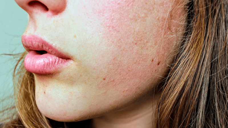 hoc-ngay-cach-nhan-biet-da-bi-di-ung-va-day-mun-khi-dung-aha-bha-retinoids-16-png