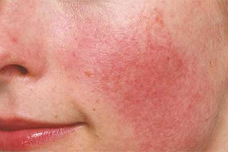hoc-ngay-cach-nhan-biet-da-bi-di-ung-va-day-mun-khi-dung-aha-bha-retinoids-16-jpg