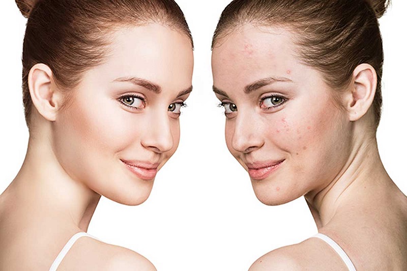 hoc-ngay-cach-nhan-biet-da-bi-di-ung-va-day-mun-khi-dung-aha-bha-retinoids-17-jpg