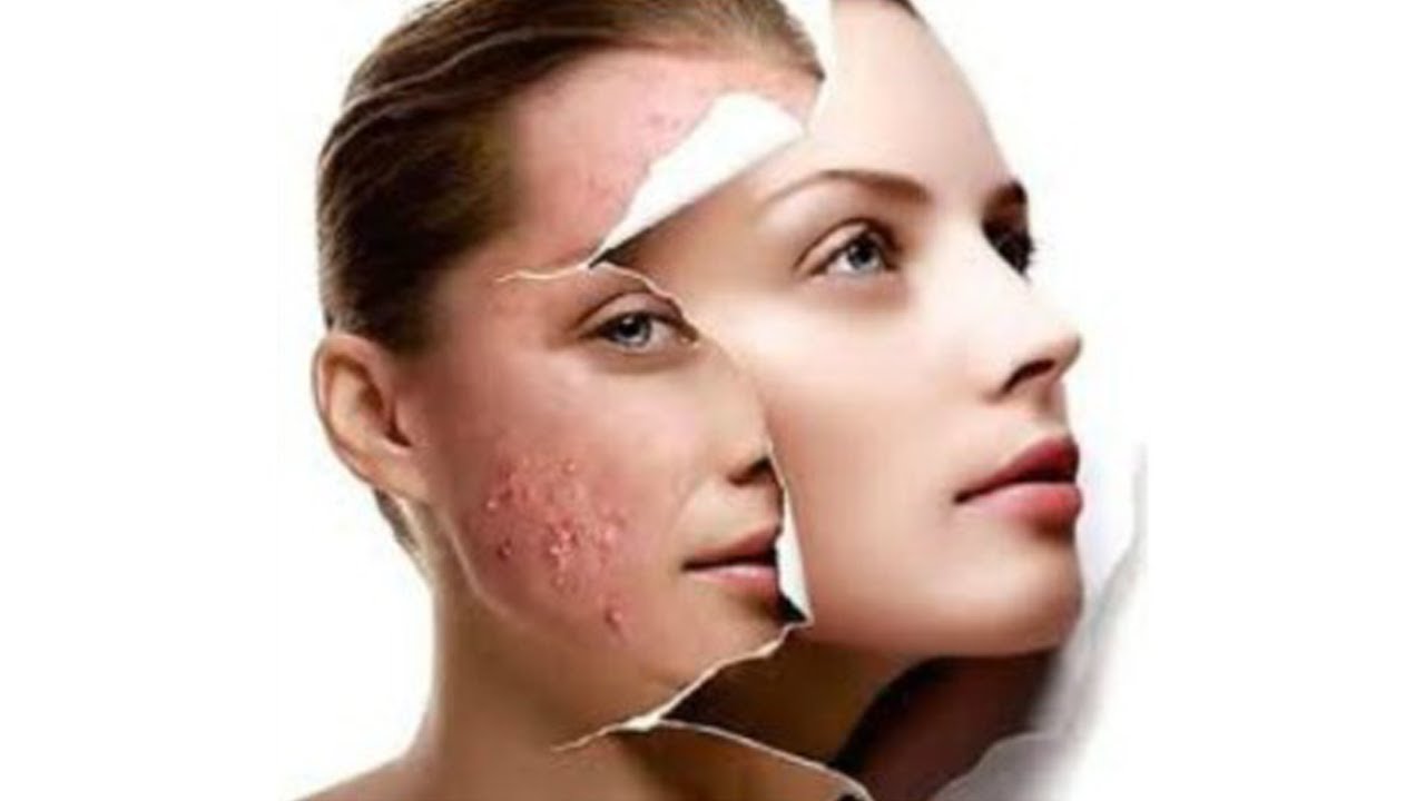 hoc-ngay-cach-nhan-biet-da-bi-di-ung-va-day-mun-khi-dung-aha-bha-retinoids-19-jpg