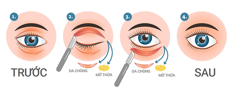 diem-danh-cac-cach-dieu-tri-quang-tham-bong-mat-tu-co-ban-den-chuyen-sau-boshop-2-jpg