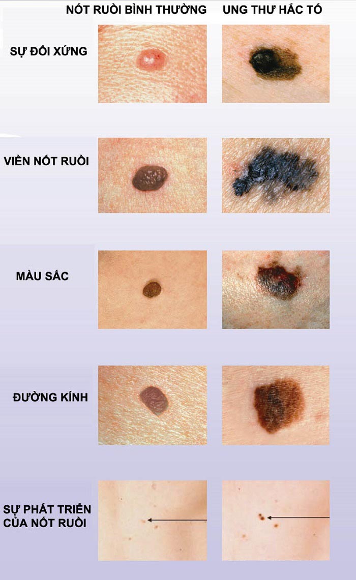 huong-dan-xoa-not-ruoi-an-toan-khong-dau-don-phan-1-3-jpg