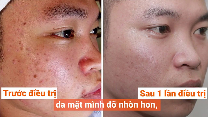 bi-quyet-dieu-tri-mun-mu-sung-do-o-mat-ma-nang-nen-biet-boshop-10-jpg