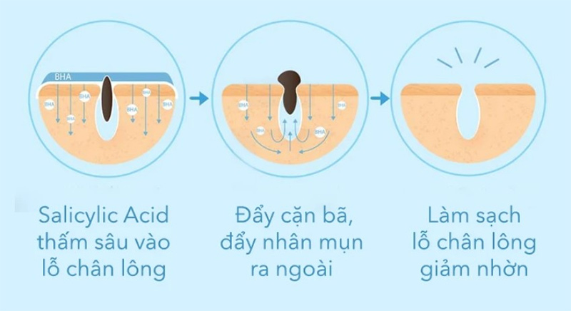 bi-quyet-dieu-tri-mun-mu-sung-do-o-mat-ma-nang-nen-biet-boshop-14-jpg