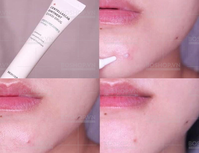 tinh-chat-cham-mun-skin1004-centellascar-ointment-quasi-drug-10ml-boshop-3-jpg