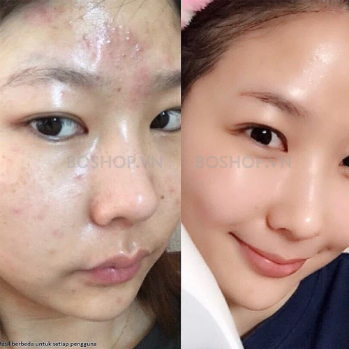 gel-tri-mun-mo-tham-chong-lao-hoa-menarini-tretinoin-gel-usp-01-20g-boshop-7-jpg