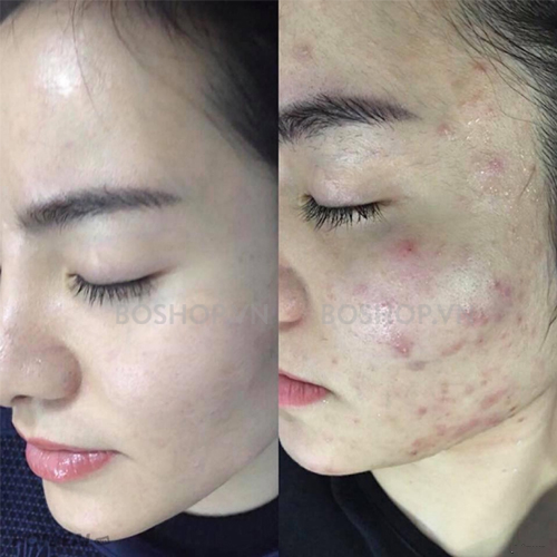 gel-tri-mun-mo-tham-chong-lao-hoa-menarini-tretinoin-gel-usp-01-20g-boshop-8-jpg