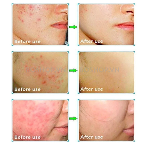 kem-tri-mun-mo-tham-skinoren-cream-for-the-treatment-of-acne-and-melasma-30g-boshop-4-jpg