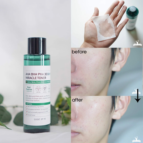 nuoc-hoa-hong-tri-mun-some-by-mi-aha-bha-pha-30-days-miracle-toner-150ml-boshop-5-jpg