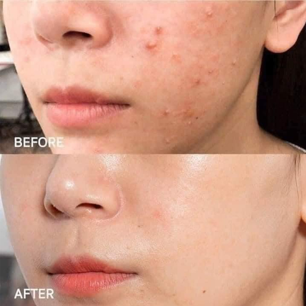 tinh-chat-giam-mun-mo-tham-mem-min-da-svr-sebiaclear-serum-30ml-boshop-5-jpg