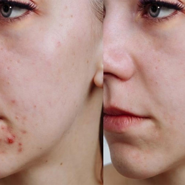 kem-tri-mun-mo-tham-acne-derm-kwas-azelainowy-20-20g-boshop-10-jpg