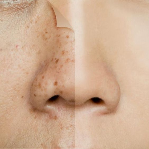 niacinamide-chia-khoa-giup-giai-quyet-cac-van-de-da-tham-mun-boshop-15-jpg