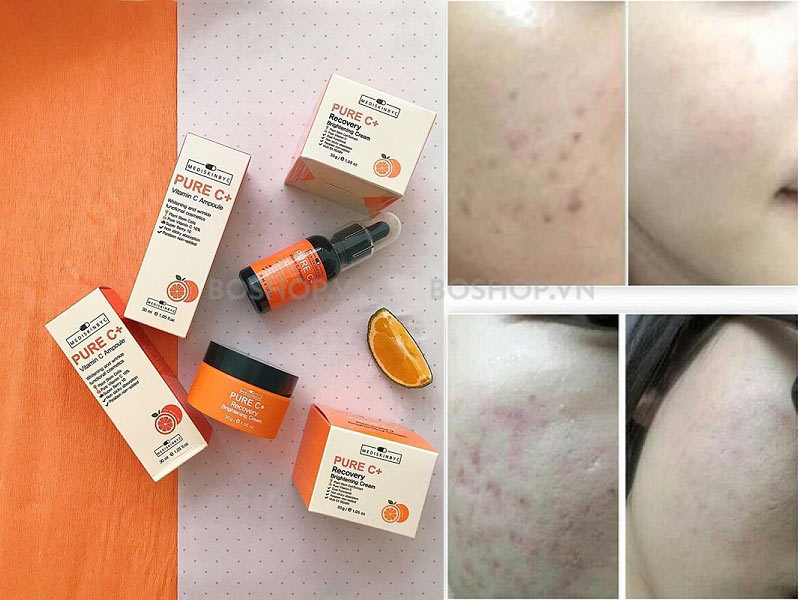 Hiệu quả của bộ đôi trị mụn thần thánh dưỡng sáng siêu tốc MediskinbyC chiết xuất Vitamin C đối với da là điều không thể bàn cãi