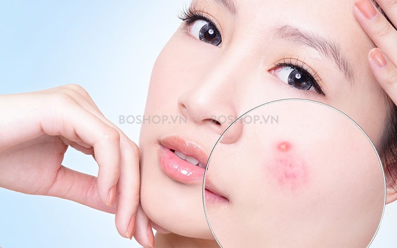Sữa rửa mặt ngăn ngừa mụn hiệu quả