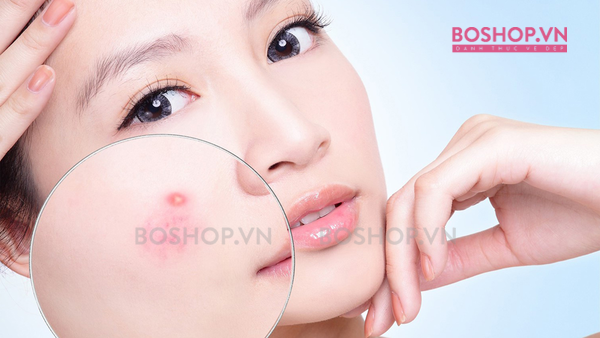 Kem trị mụn hiệu quả giúp giảm sưng khô mụn hiệu quả