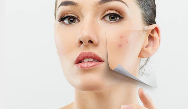 Kem dưỡng ẩm da mụn Simple Spotless Skin dưỡng ẩm tốt, phù hợp cho cả da khô, dễ bị dị ứng